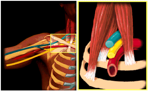 thoracic outlet syndrome 2